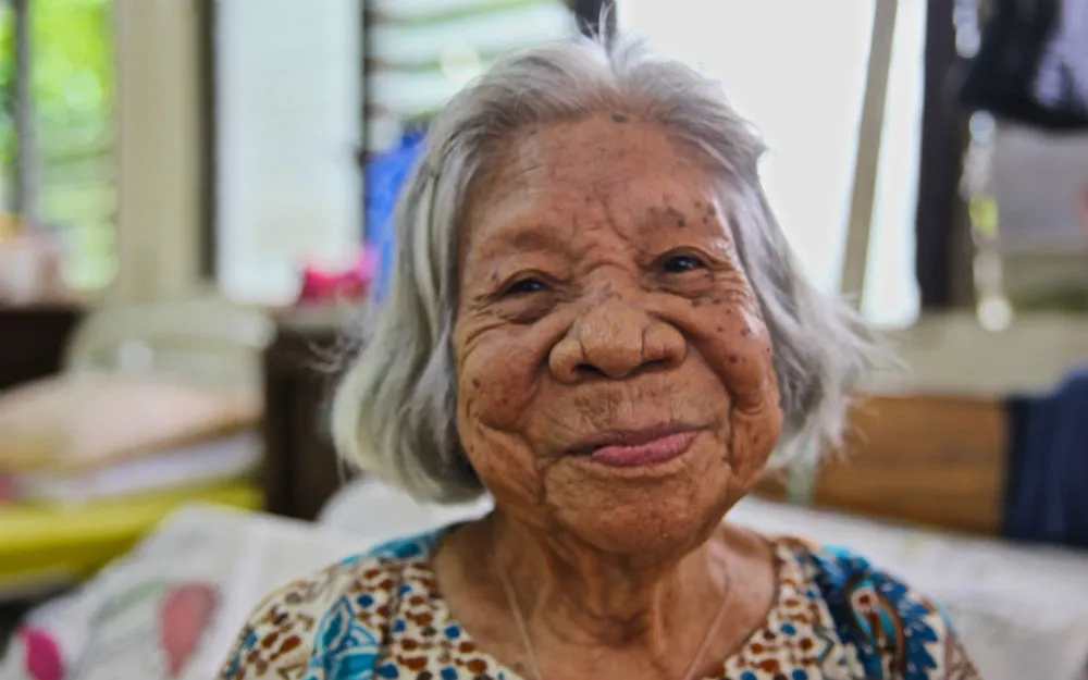 Catalina lives in a hospital due to blindness and nerve damage from leprosy