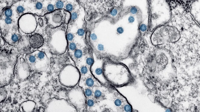 Transmission electron microscopic image of an isolate from a case of coronavirus disease (COVID-19)